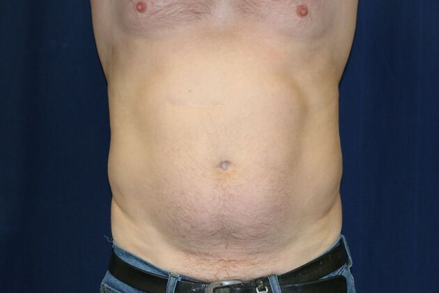 Abdominal Etching : Case 3 - Before