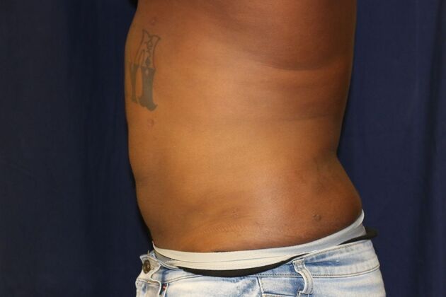 Abdominal Etching : Case 4 - After