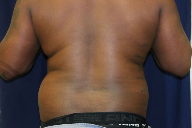 Abdominal Etching : Case 4 - Before