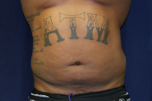 Abdominal Etching : Case 4 - Before