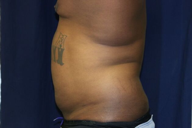 Abdominal Etching : Case 4 - Before