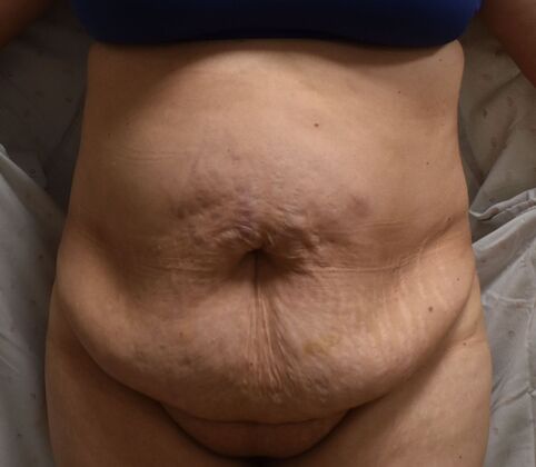Tummy Tuck (Abdominoplasty): Case 414 - Before