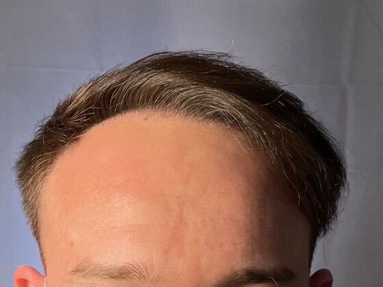 FUT Hair Restoration: Case 26 - After