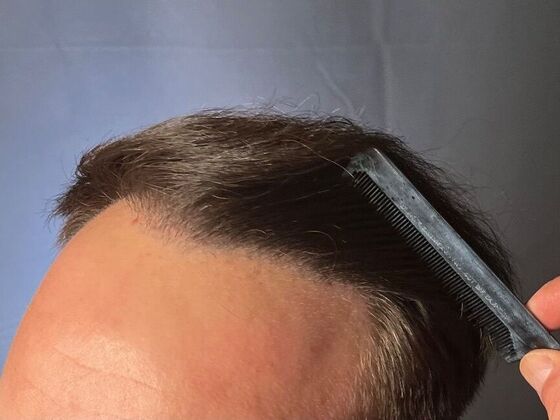 FUT Hair Restoration: Case 26 - After