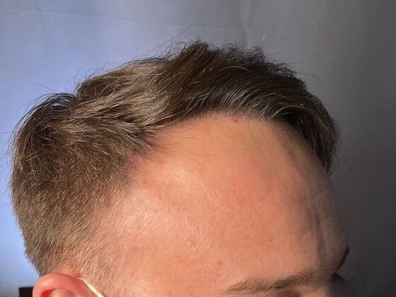 FUT Hair Restoration: Case 26 - After