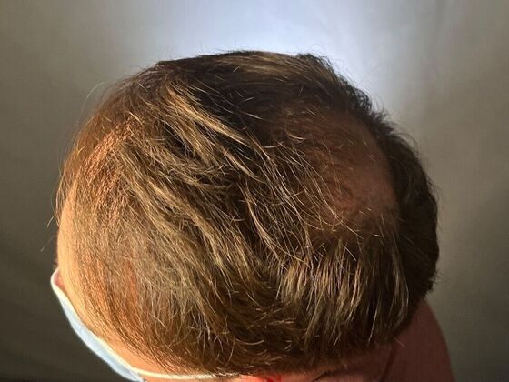 FUT Hair Restoration Case 26 - After