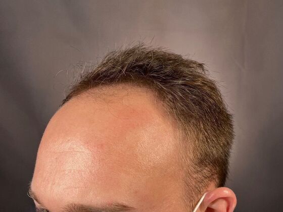 FUT Hair Restoration: Case 26 - Before