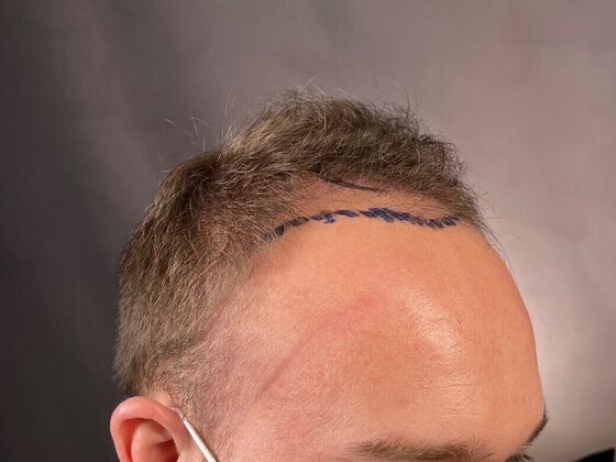 FUT Hair Restoration: Case 26 - Before