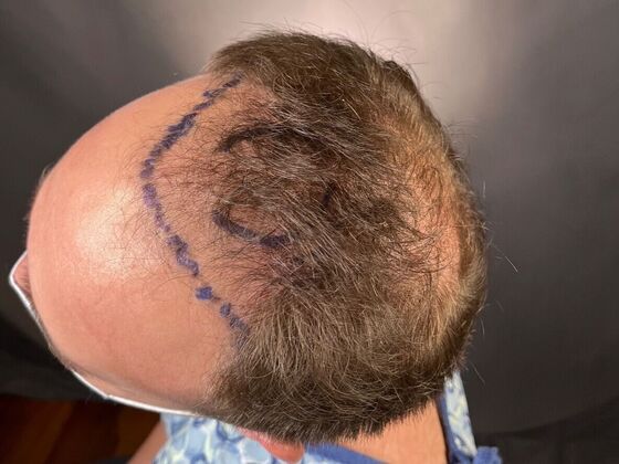 FUT Hair Restoration Case 26 - Before