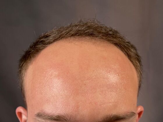 FUT Hair Restoration: Case 26 - Before