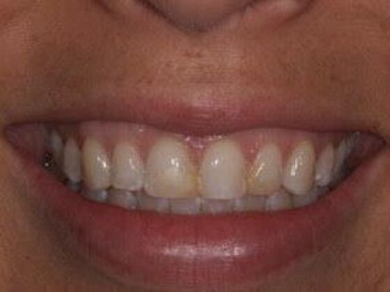 Veneers: Amanda - Before
