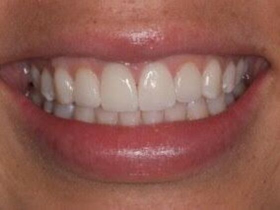 Veneers: Amanda - After