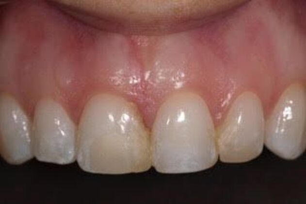 Veneers: Amanda - Before