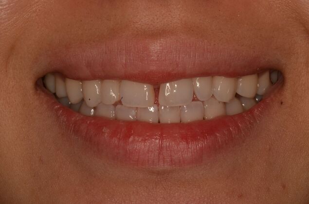 Composite Bonding: Case 9 - Before