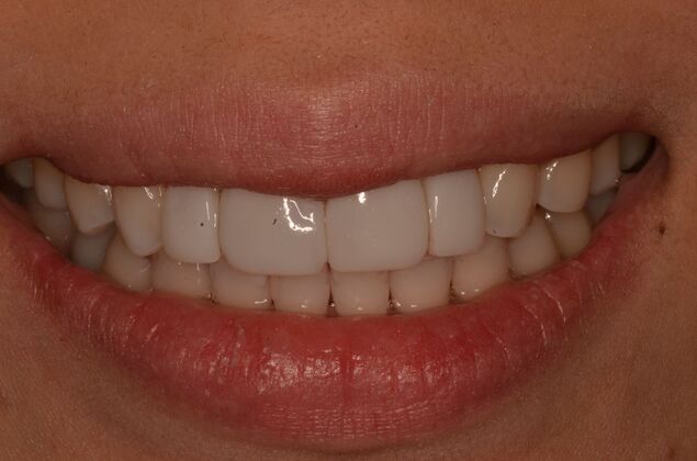 Composite Bonding: Case 9 - After