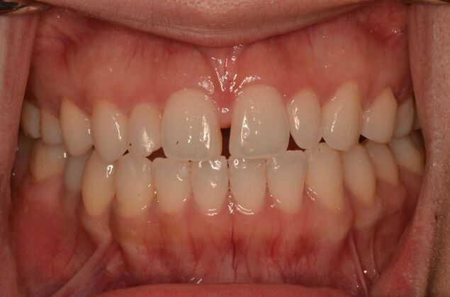 Composite Bonding: Case 9 - Before
