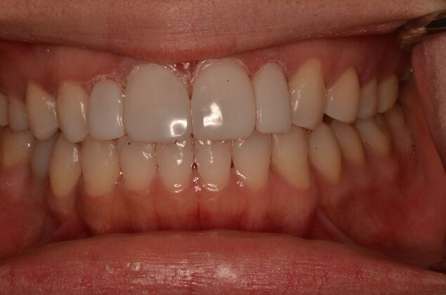 Composite Bonding: Case 9 - After
