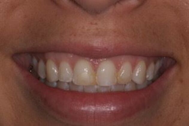 Veneers Amanda - Before