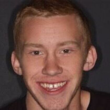 Smile Makeover Alex - Before