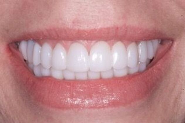 Dental Implants: Laura - After