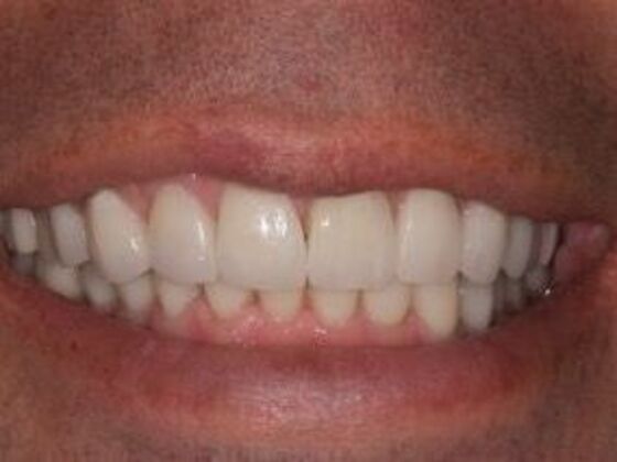 Dental Implants Steve - After