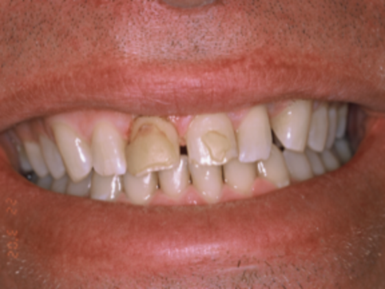 Dental Implants Steve - Before