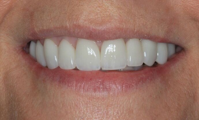 Full Mouth Reconstruction: Case 37 - After