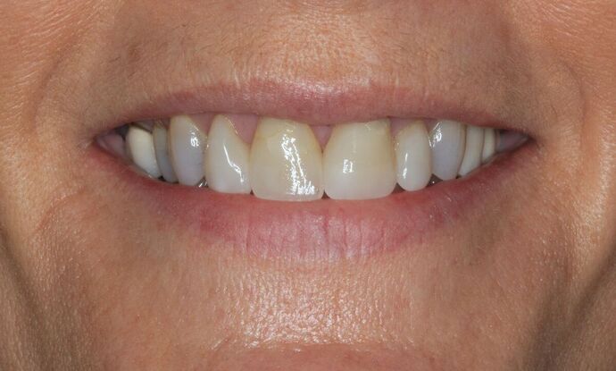 Full Mouth Reconstruction: Case 37 - Before