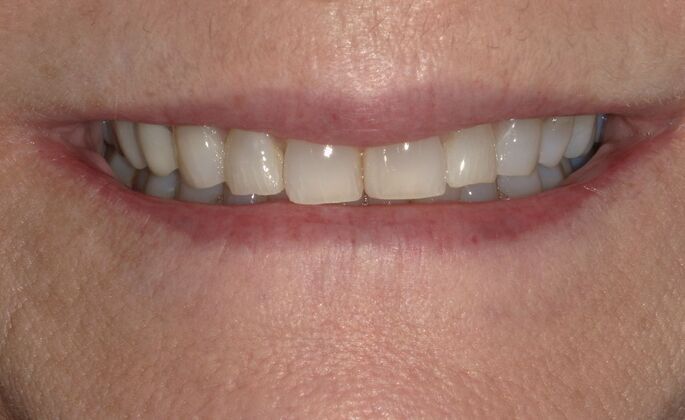 Full Mouth Reconstruction: Case 38 - Before