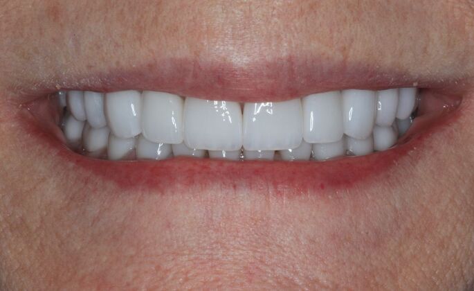 Full Mouth Reconstruction: Case 38 - After