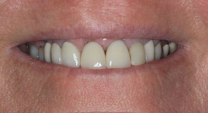 Full Mouth Reconstruction: Case 39 - Before