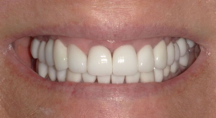 Full Mouth Reconstruction: Case 39 - After