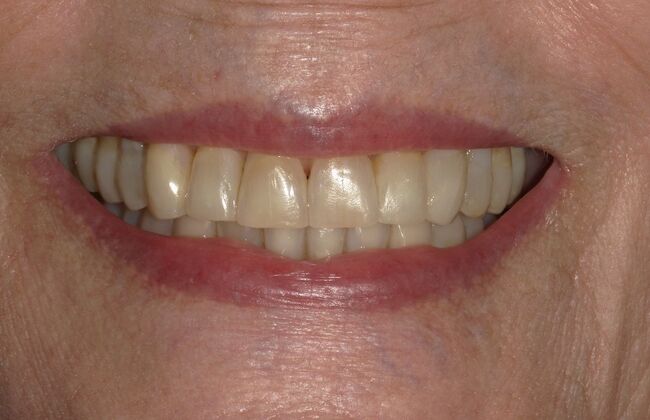 Full Mouth Reconstruction: Case 36 - Before