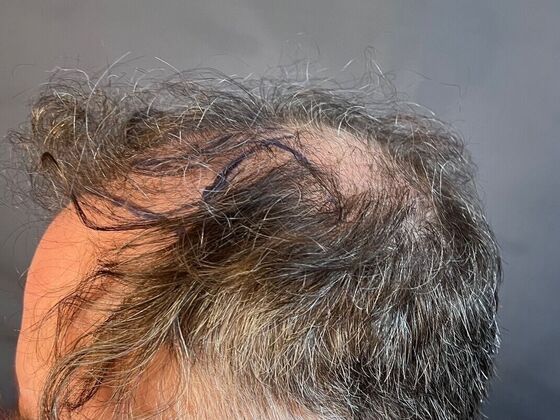 FUT Hair Restoration: Case 27 - After