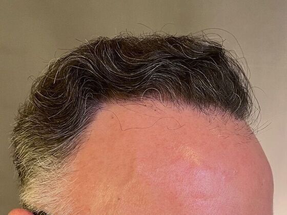 FUT Hair Restoration: Case 27 - After