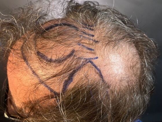 FUT Hair Restoration: Case 27 - After