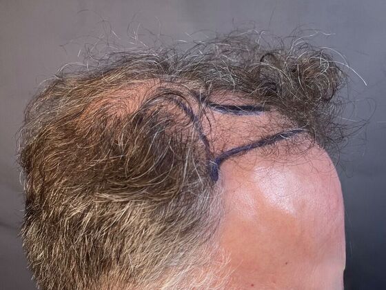 FUT Hair Restoration: Case 27 - Before