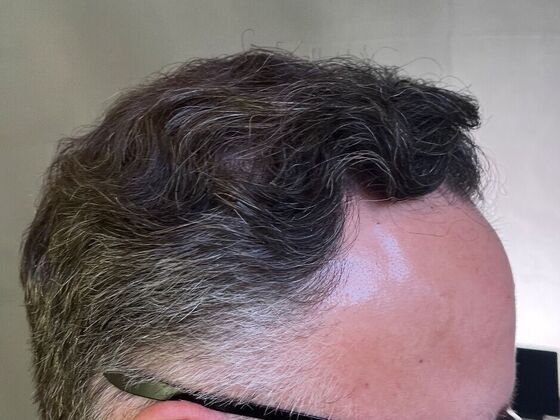 FUT Hair Restoration: Case 27 - After