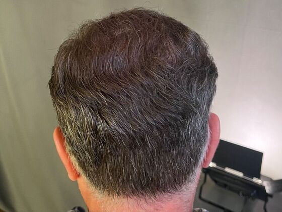 FUT Hair Restoration: Case 27 - After