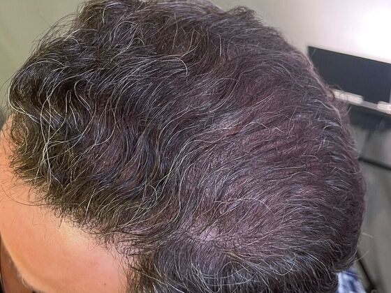 FUT Hair Restoration: Case 27 - Before