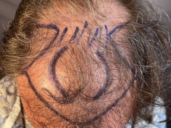 FUT Hair Restoration: Case 27 - Before