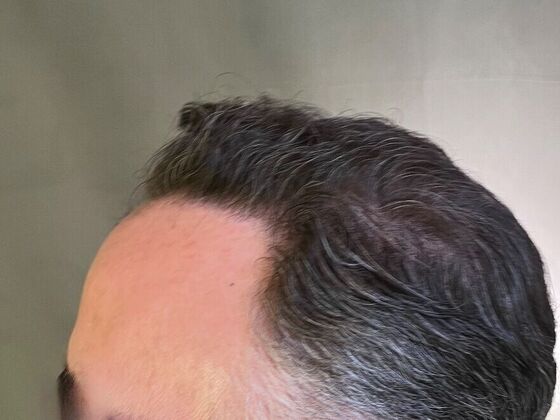 FUT Hair Restoration: Case 27 - Before