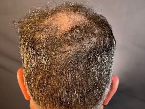 FUT Hair Restoration: Case 27 - Before