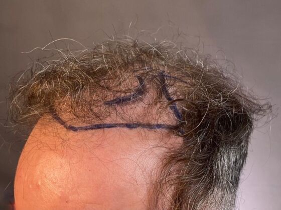 FUT Hair Restoration: Case 27 - Before