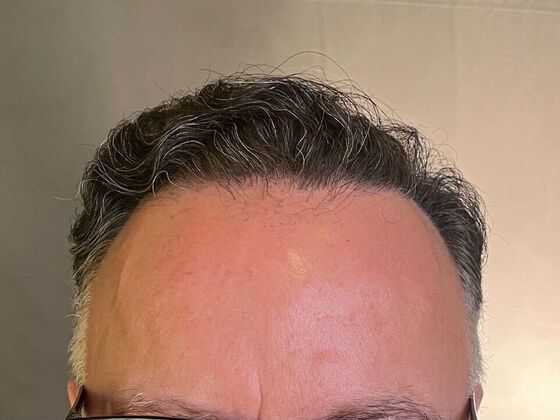 FUT Hair Restoration Case 27 - After