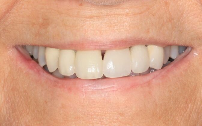Full Mouth Reconstruction: Case 40 - Before