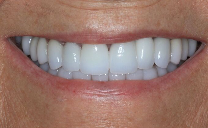 Full Mouth Reconstruction: Case 40 - After