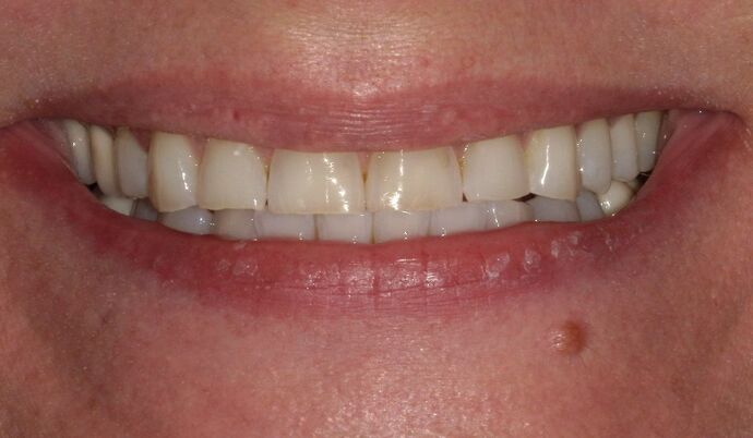 Full Mouth Reconstruction Case 41 - Before