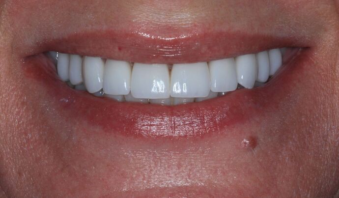 Full Mouth Reconstruction Case 41 - After