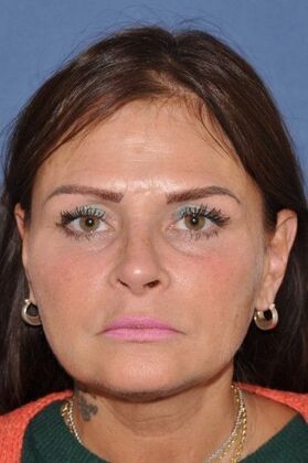 Endoscopic Browlift: Endoscopic Browlift and Facelift at 6 months - Before